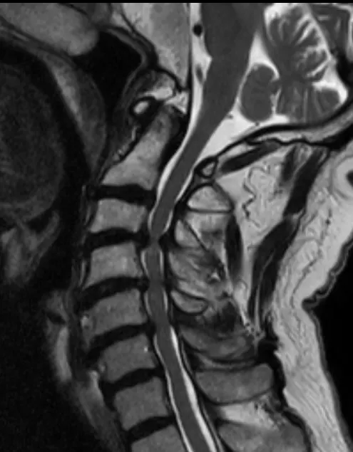 MRI עמש צווארי